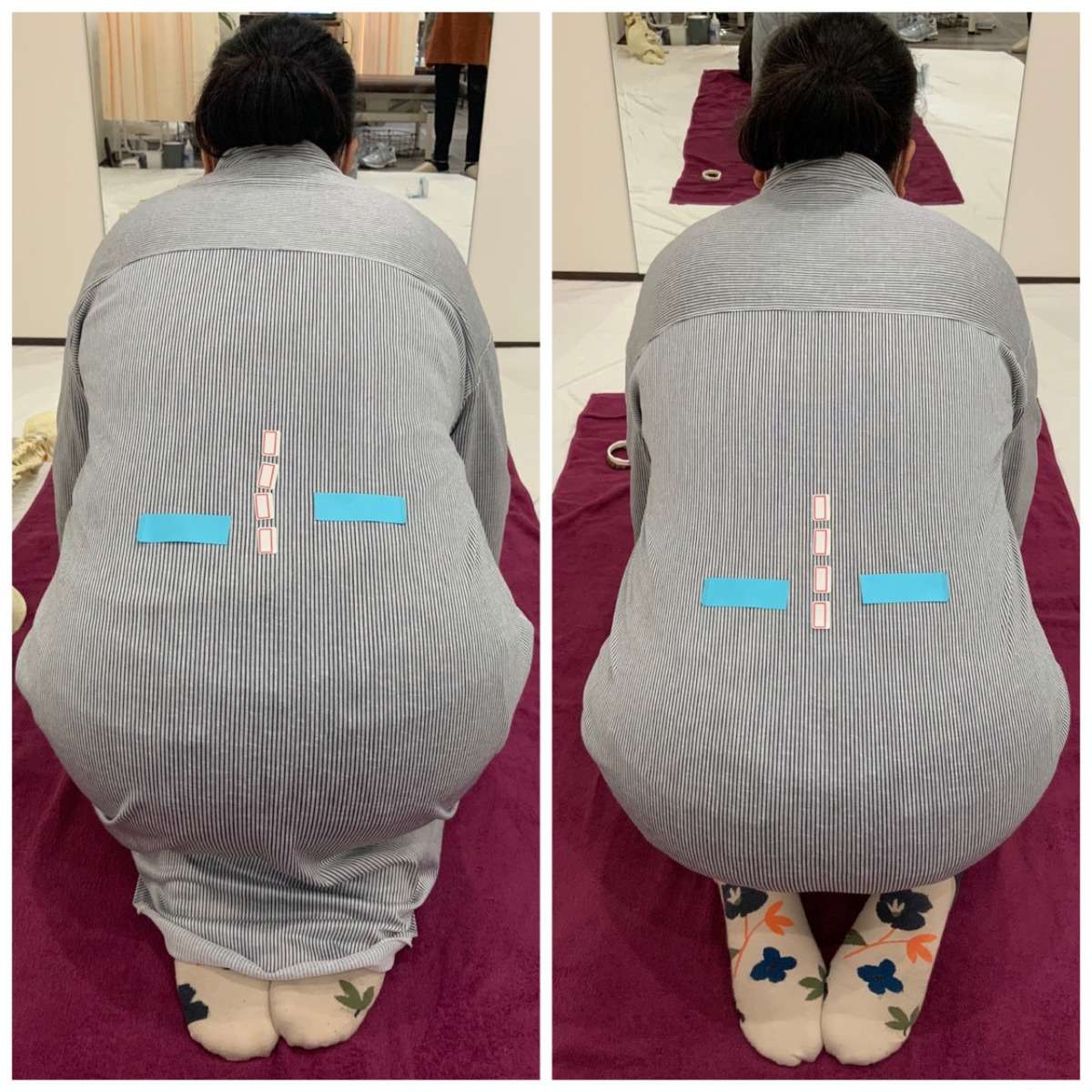 腰痛、肩こり 体の歪みを整えることで改善