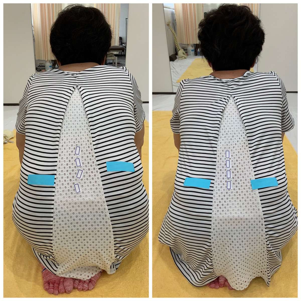 坐骨神経痛 体の歪みを整えることで改善